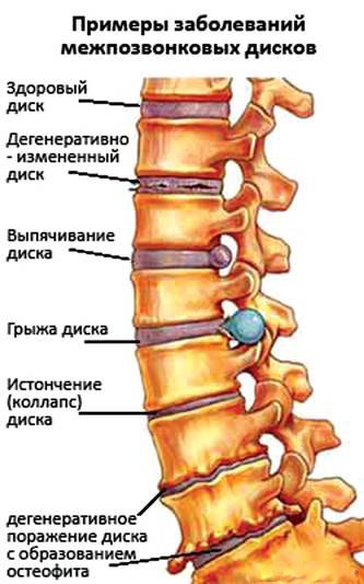 Фитотерапия при болях в позвоночнике