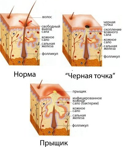 Противник акне