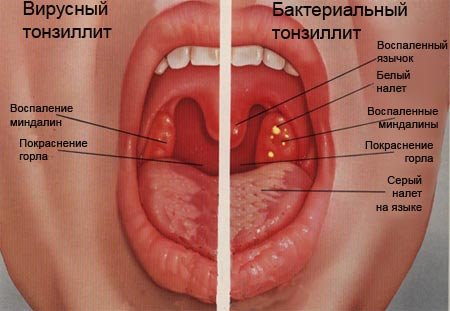 Ангина (тонзиллит). Причины возникновения, основные формы, проявления, методы диагностики, лечения и профилактики