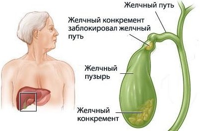 желчекаменная болезнь
