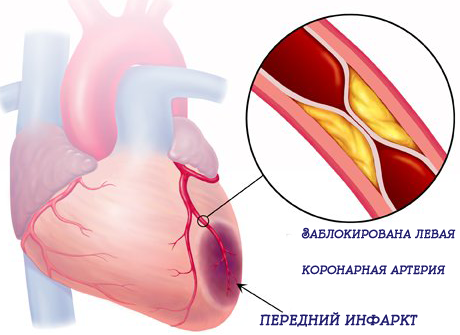 инфаркт
