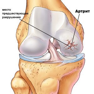Как облегчить процесс приготовления пищи, если у вас ревматоидный артрит