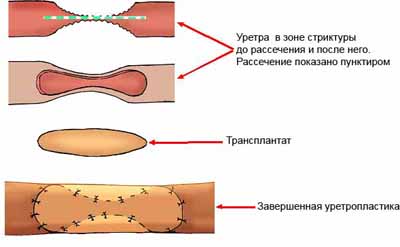 Стриктура уретры