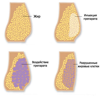 Мезодиссолюция: коррекция фигуры без вреда для здоровья