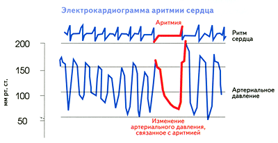 Аритмия