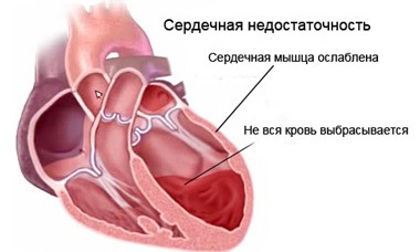 Застойная сердечная недостаточность