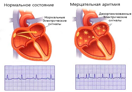 Мерцательная аритмия