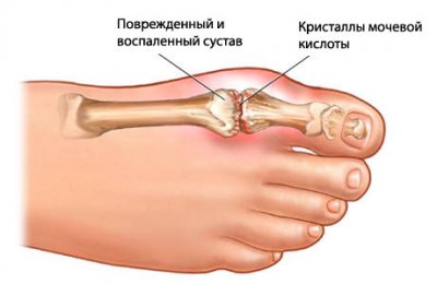 Собрание народных методов лечения подагры
