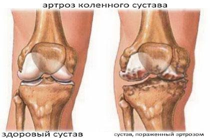 Народные средства против артроза