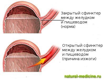 Как лечить изжогу