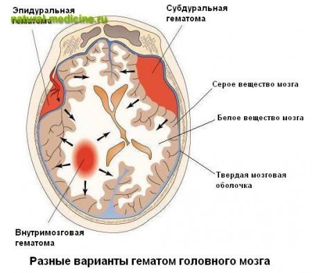 Какие бывают гематомы: виды