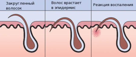 Как волос врастает в кожу