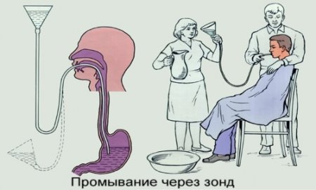 Промывание желудка через зонд