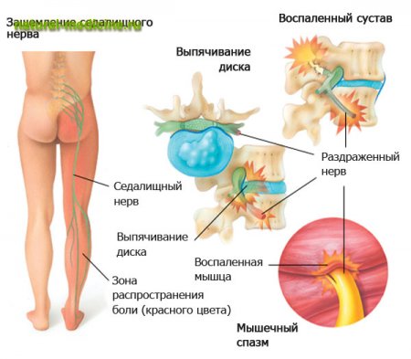 Радикулит