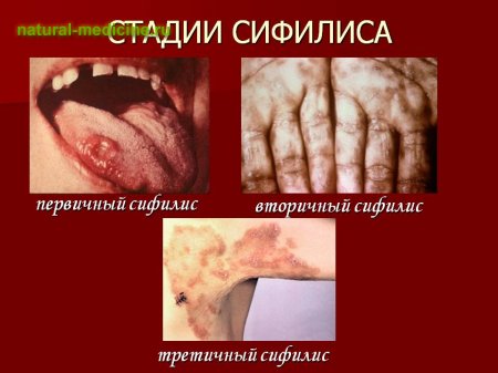 Стадии сифилиса