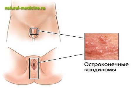 Кондиломы