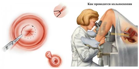 Биопсия и кольпоскопия