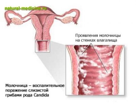 Молочница