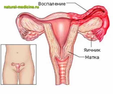 воспаление придатков