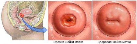 эрозия шейки матки