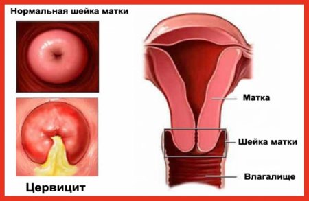 гнойный цервицит