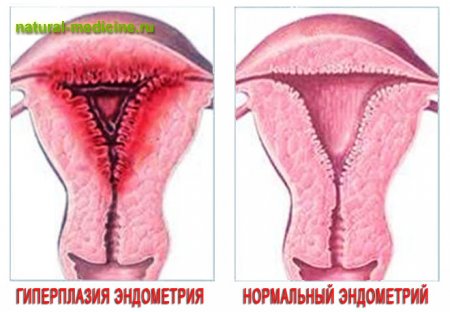 гиперплазия эндометрия
