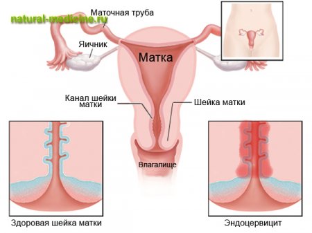 эндоцервицит