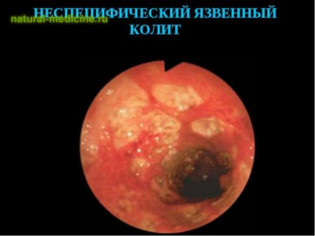 Неспецифический язвенный колит