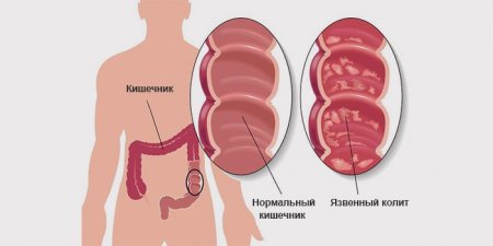 Колит и дисбактериоз кишечника