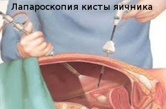 Лапаротомия яичника: подготовка, проведение, восстановление