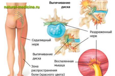 Что такое боль в седалищном нерве